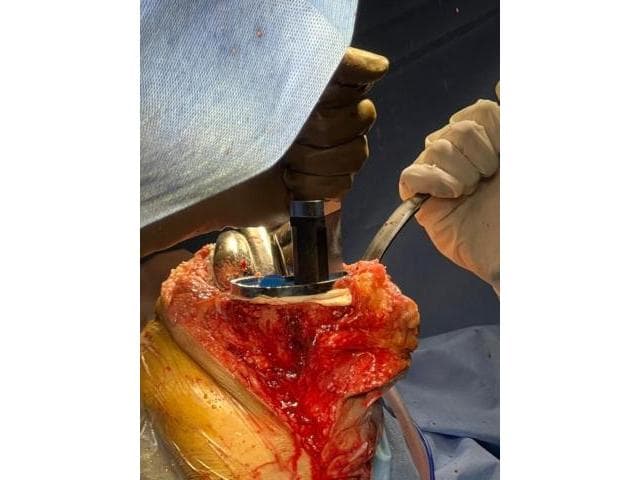 Best Knee Replacement in Meerut