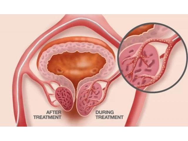 BPH Treatment In India